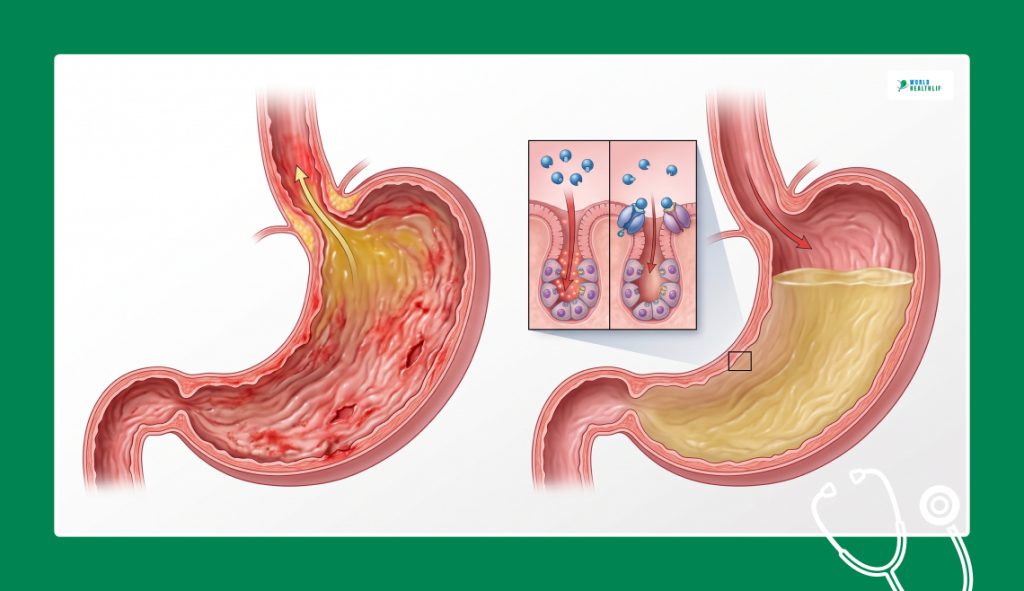 what Are Proton Pump Inhibitors