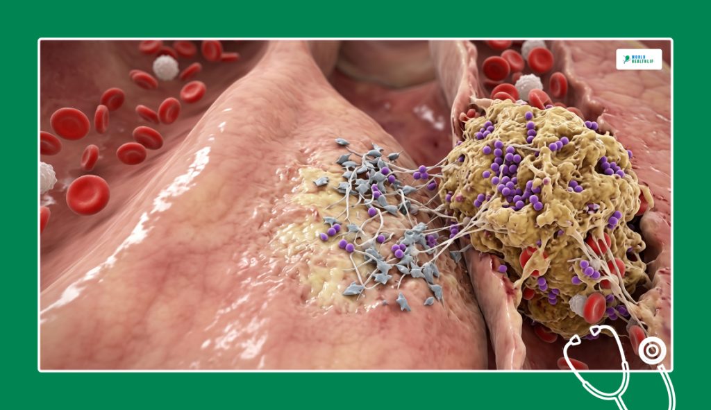 The Microscopic Sandbox_ How Endocarditis Takes Hold