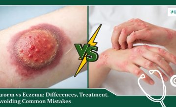ringworm vs eczema