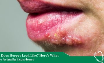 what does herpes look like