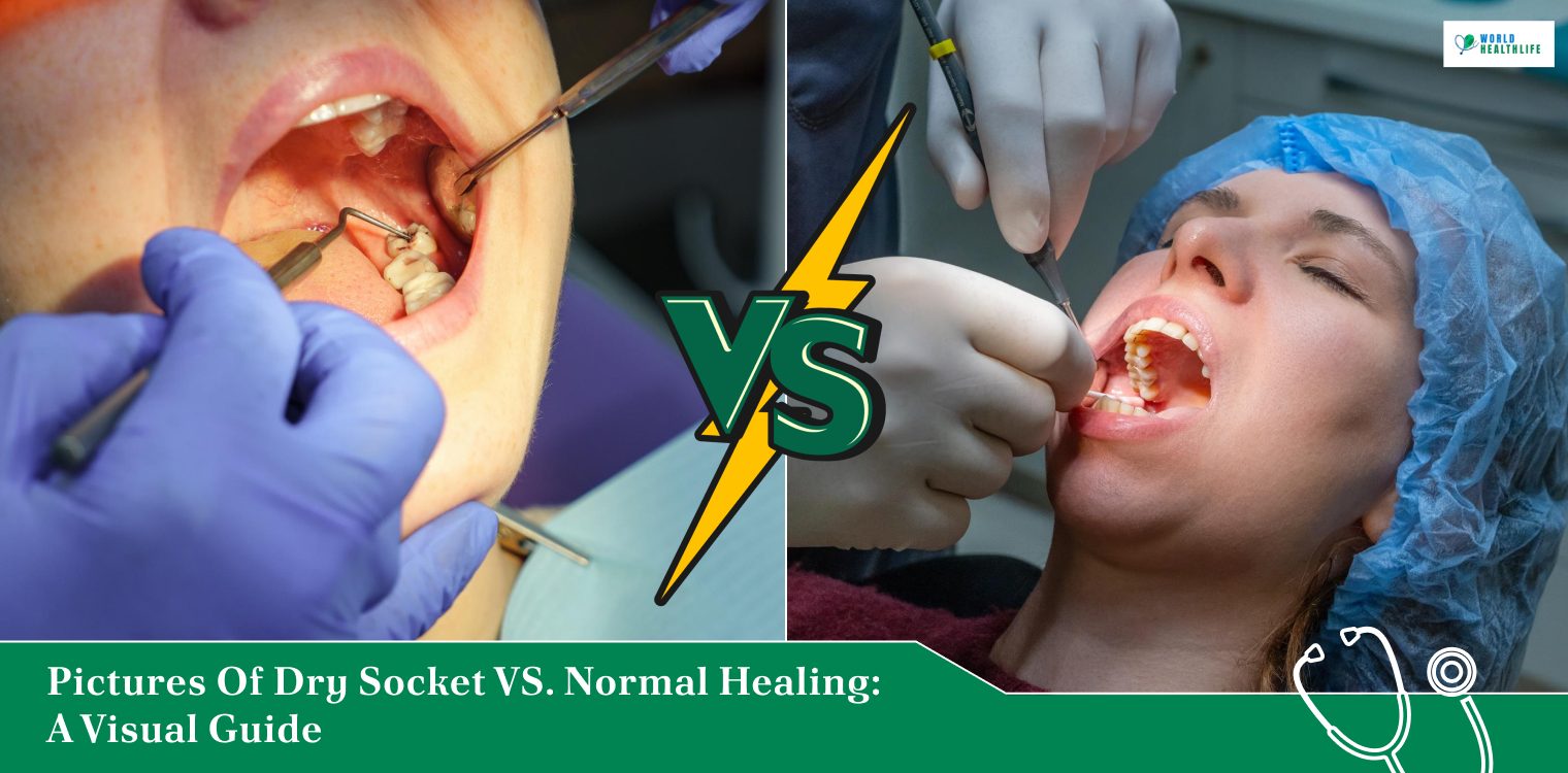 pictures of dry socket vs normal healing