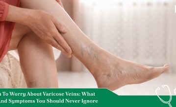 when to worry about varicose veins
