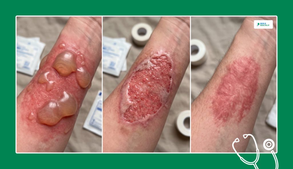 Chronological Breakdown Of The 2nd Degree Burn Healing Stages