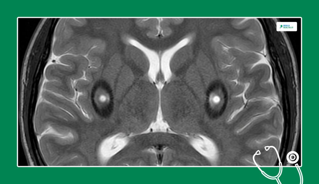 The Diagnostic Signature On Brain MRIs
