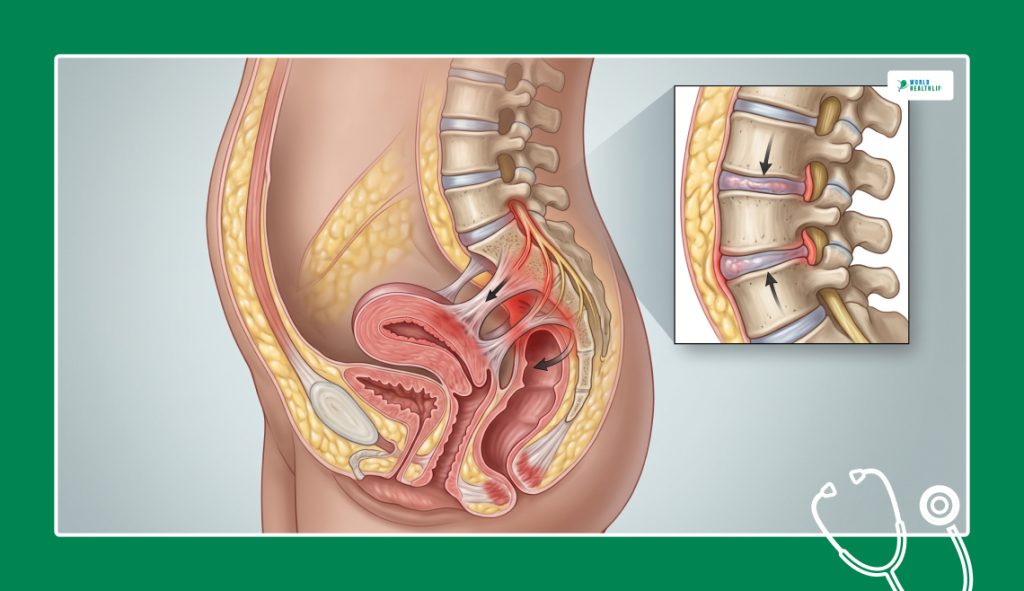 The Pelvic-Spinal Axis_ Interlinking Internal Inflammations