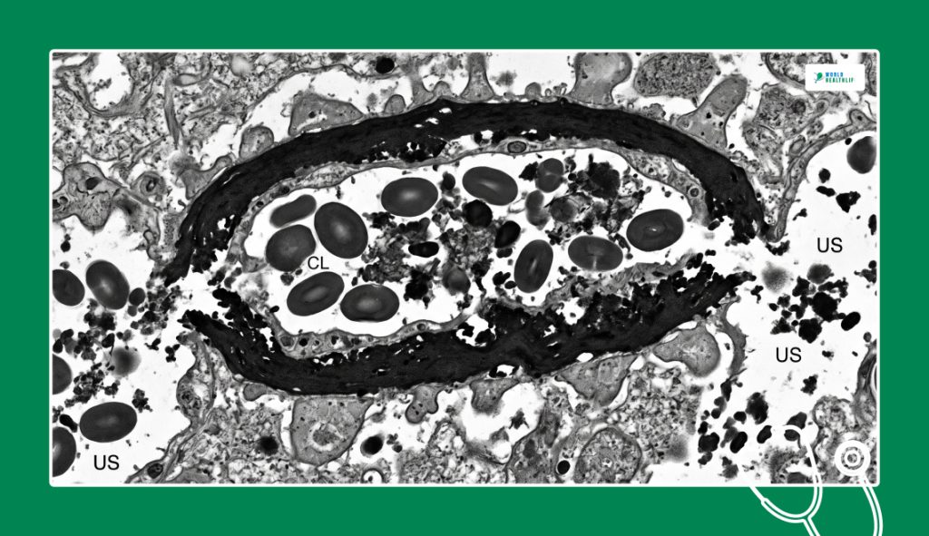 What Is Dense Deposit Disease