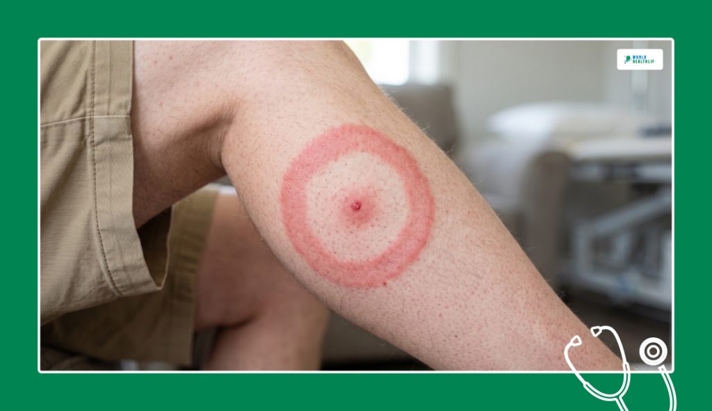 Non-Itchy Lyme Disease Circle