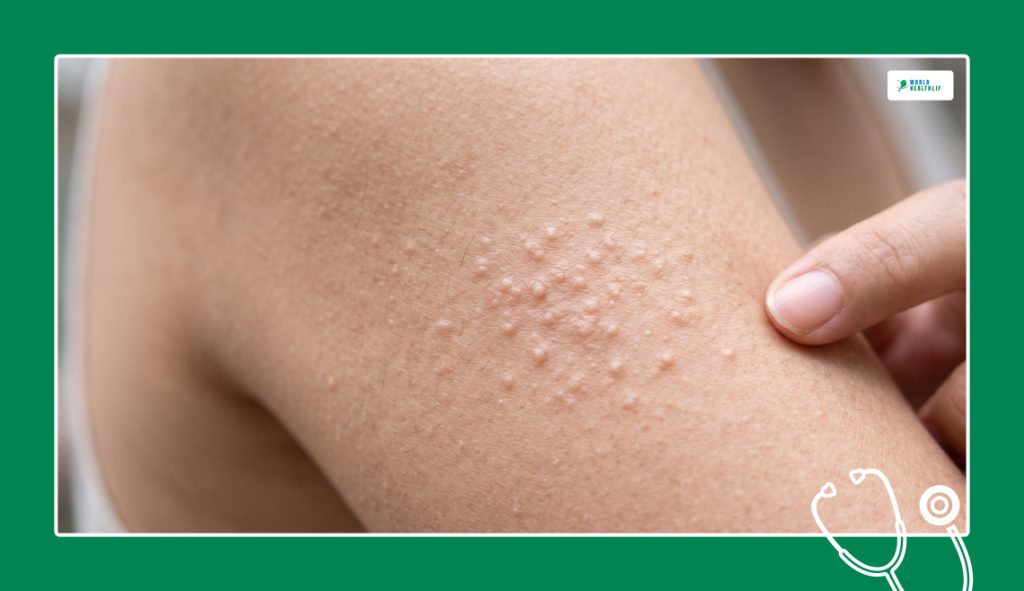 What Are These Tiny Colorless Itchy Bumps On Skin